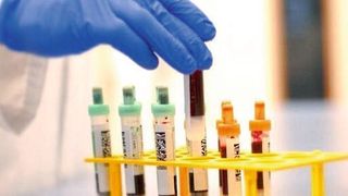 Ein spezieller Bluttest ermöglicht die Diagnose der Alzheimerschen Erkrankung. (Universität Leipzig)