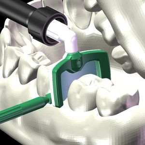 Ohne die Interdentalkeile kommt der Applikator nicht  in die Zahnzwischenräume. Die Weltneuheit Icon DMG zur bohrerlosen Kariesbekämpfung wurde von Proto Labs gefertigt.
