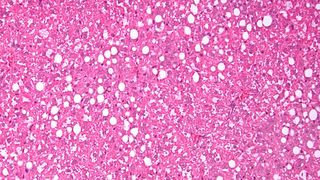 Die mikroskopische Aufnahme zeigt eine Fettleber. Die weißen "Flecken" sind sozusagen die Fetttröpfchen im Gewebe. (Bild: AG Kiemer/Saar-Uni)