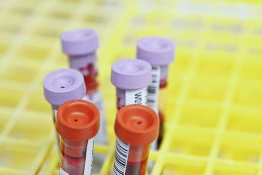 Künftig könnte der Elecsys pTau181 Bluttest genutzt werden, um Alzheimer anhand von Blutproben auszuschließen. (Symbolbild)(Bild:  frei lizenziert/ National Cancer Institute / Unsplash)