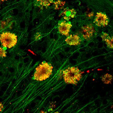 Seen by fluorescent microscopy: flower-like formations of autophagic vacuoles in neurons of Alzheimer’s disease mouse.