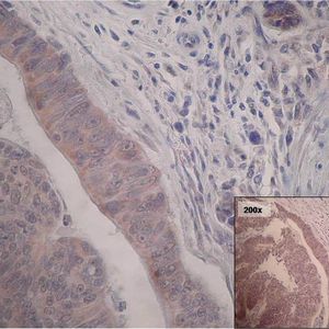 1 Immunhistochemische Analyse eines Mamma-Karzinoms mit monoklonalem Antikörper (YB-medic, ABIN172111) gegen das Kälteschockprotein YB-1.