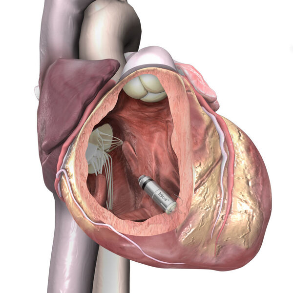 So kommt Micra in die rechte Herzkammer: Der Arzt führt ein „strohhalmartiges“ Kathetersystem in eine Vene ein. Üblicherweise geschieht dies im Bereich des oberen Oberschenkels. Das Kathetersystem transportiert die Micra-Kardiokapsel in die rechte Herzkammer. Dort wird die Kardiokapsel an der Herzwand positioniert und mit flexiblen Fixierungsankern gesichert. Anschließend wird die Kardiokapsel mit einem externen Programmiergerät getestet und eingestellt und das Kathetersystem aus dem Körper entfernt.  (Medtronic)