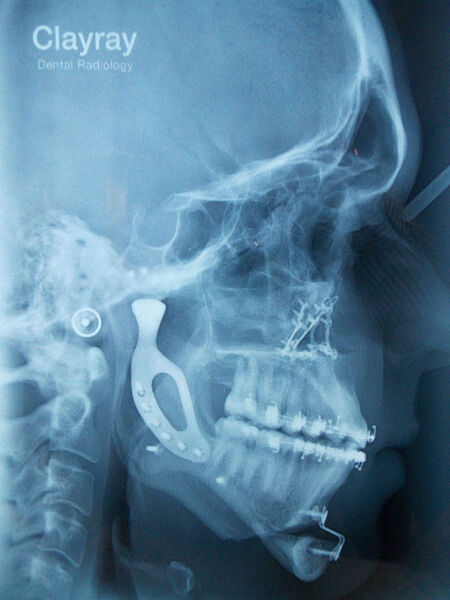 Röntgenbild des Schädels: Das Implantat ist deutlich zu erkennen. (3D MEDICA)