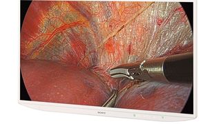 Der LMD-XH550MD ist so konstruiert, dass auch in hell ausgeleuchteten OP-Sälen Blendeffekte minimiert werden, damit OP-Teams ein klares Bild mit hohen Kontrasten erhalten. (Bild: Sony)