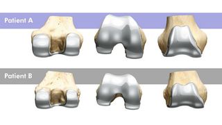 Im Zentrum für Orthopädie und Unfallchirurgie der Universitätsmedizin Mainz kommen jetzt Knieimplantate zum Einsatz, die individuell auf die Anatomie des Patienten abgestimmt sind. Hier zu sehen: die Oberschenkelknochen zweier Patienten mit jeweils individuellen Knieimplantaten aus der Perspektive von oben, von der Seite und von hinten.  (Conformis Inc. Bedford/USA)