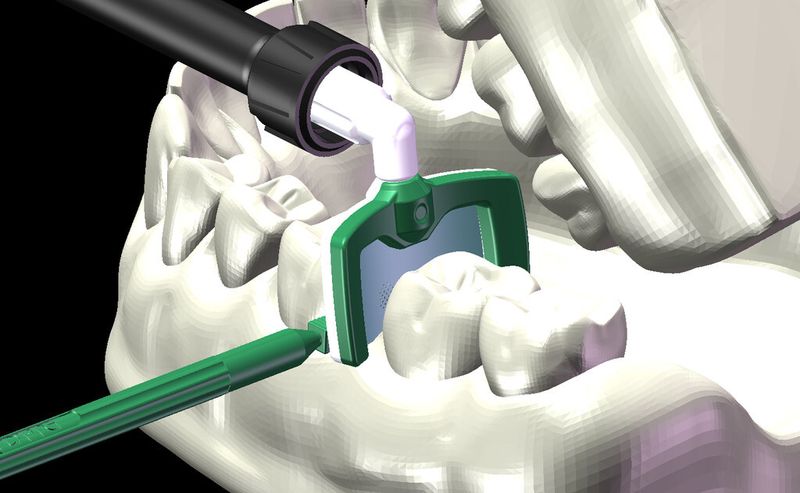 Ohne die Interdentalkeile kommt der Applikator nicht  in die Zahnzwischenräume. Die Weltneuheit Icon DMG zur bohrerlosen Kariesbekämpfung wurde von Proto Labs gefertigt. (Proto Labs)