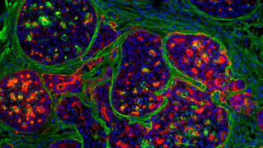 Early-stage breast cancer tumours are separated from their environment by a basement membrane that acts as a biological barrier. In the picture, localised cancer tumours (nuclei blue and cells partly red) are surrounded by the basement membrane (green). (Source:  Guillaume Jacquemet, Åbo Akademi)