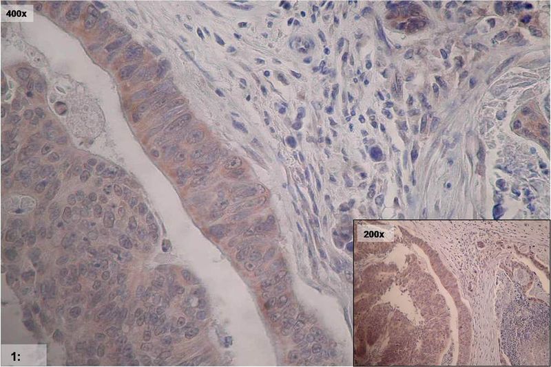 1 Immunhistochemische Analyse eines Mamma-Karzinoms mit monoklonalem Antikörper (YB-medic, ABIN172111) gegen das Kälteschockprotein YB-1. (Archiv: Vogel Business Media)