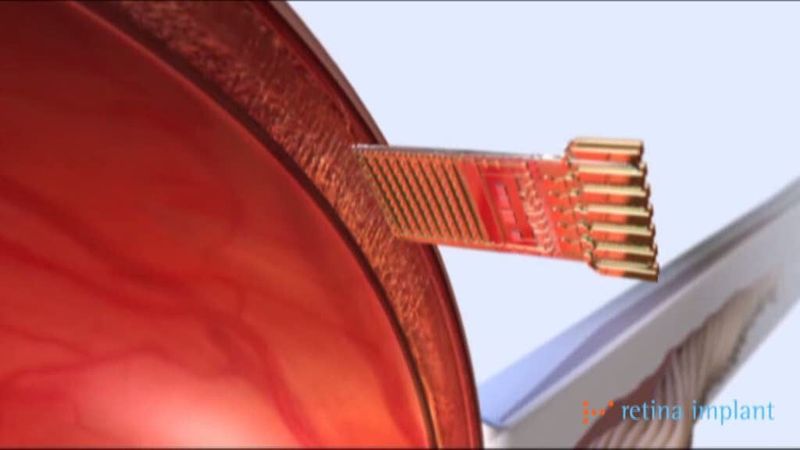 Dargestellt wird die subretinale Lokalisation des Alpha IMS Microchips. (Bild: Retina Implant AG)